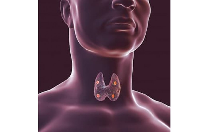 Цинакальцет: Эффективный контроль гиперпаратиреоза и гиперкальциемии