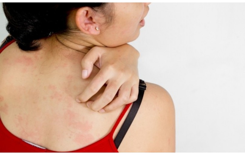 Снимает зуд и раздражение за считанные минуты: Элозон