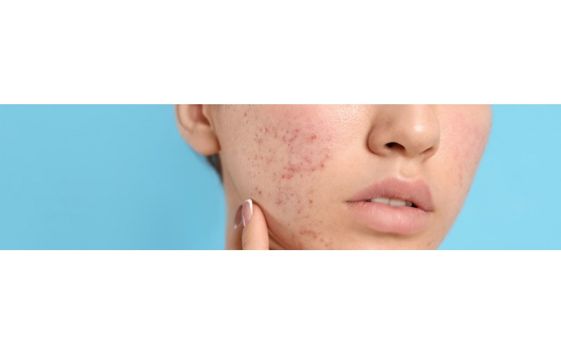 Чистая кожа без акне: как Эпидуо и Эпидуо Форте помогут вам