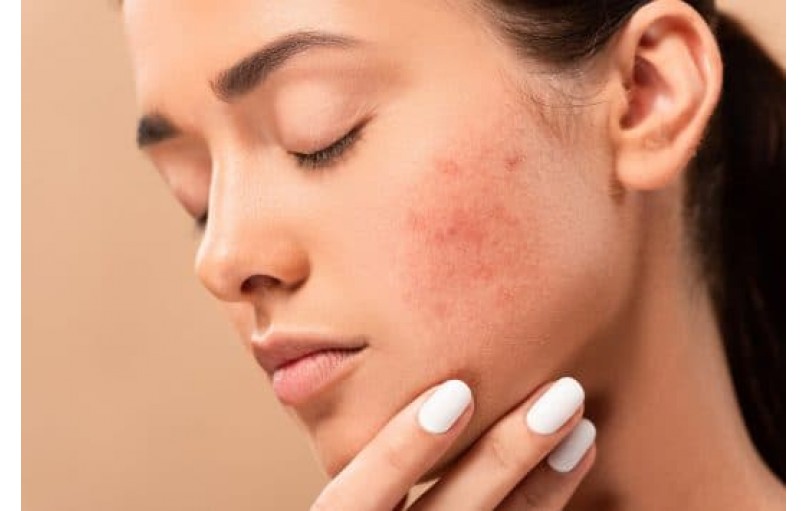 Эрифлюид: Ваш путь к чистой и здоровой коже